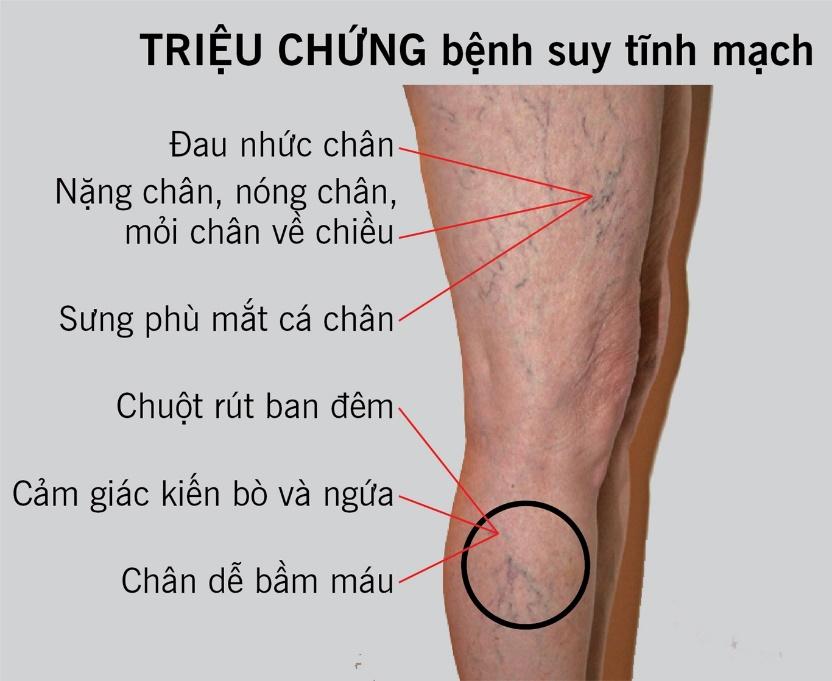 giãn tĩnh mạch chân